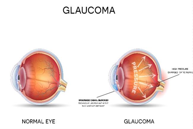 איור: עין בריאה אל מול עין עם גלאוקומה 